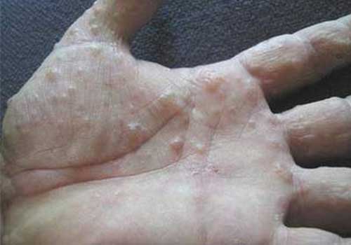 Bệnh eczema tổ đỉa là gì? Triệu chứng nguyên nhân và cách chữa