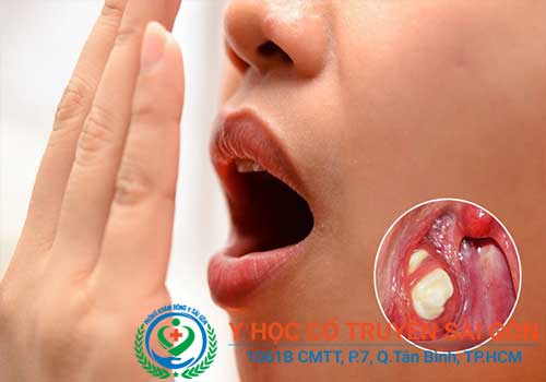 Bệnh hôi miệng có thể tự kiểm tra bằng cách thở ra bằng miệng