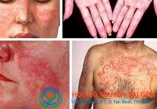 Bệnh Lupus ban đỏ gây ra tình trạng phát ban trên da