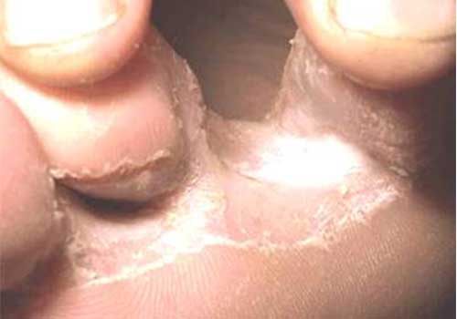 Nấm kẽ chân có thể gây nứt nẻ, chảy máu cho người bệnh