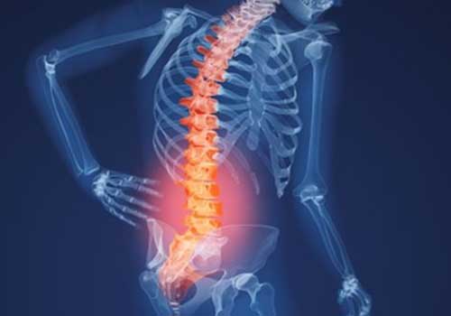 Bệnh thoái hóa cột sống thắt lưng là gì? Triệu chứng và cách phòng bệnh