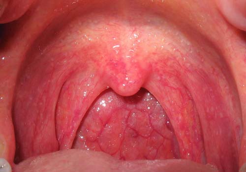 Bệnh viêm họng hạt là gì? Triệu chứng, nguyên nhân và cách chữa