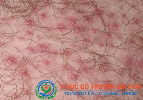 Viêm nang lông là một trong những bệnh da liễu thường gặp