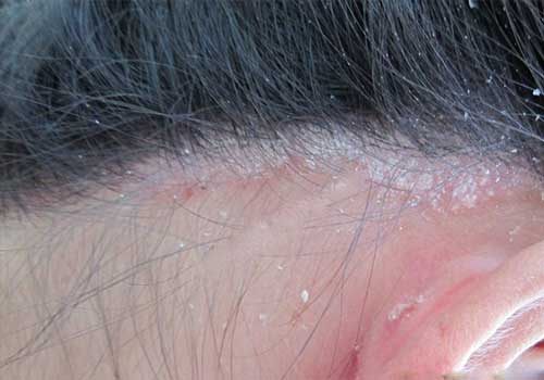 Dấu hiệu và cách chữa bệnh vảy nến da đầu
