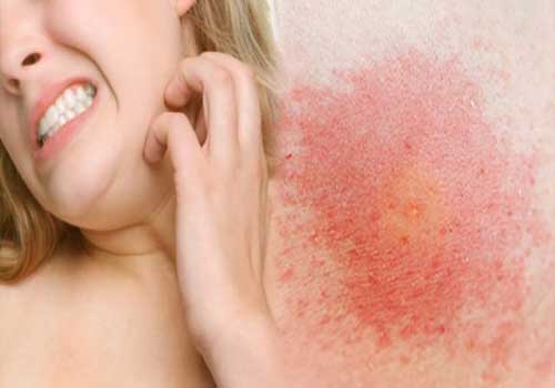 Dị ứng da là gì? Nguyên nhân, triệu chứng và cách chữa trị 2