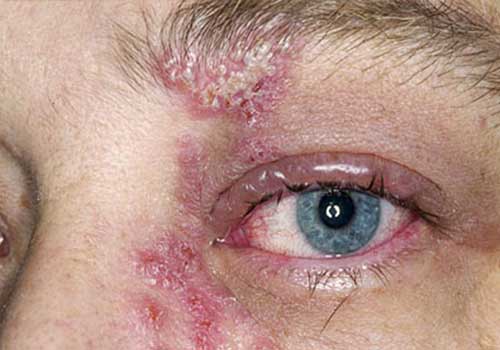 Bệnh giời leo ở mắt nếu không được khám chữa đúng cách có thể dẫn đến mù lòa