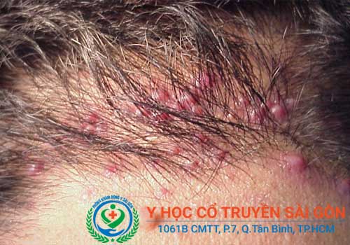 Bệnh viêm nang lông nếu không chữa sớm sẽ gây nhiều ảnh hưởng đến cuộc sống