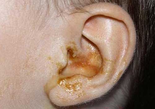 bệnh viêm tai giữa là gì