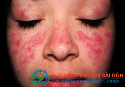 Triệu chứng điển hình của bệnh Lupus là nổi ban đỏ hình cánh bướm