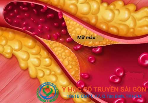 Triệu chứng của rối loạn lipid máu thường diễn ra âm thầm