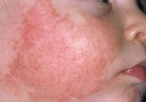 Tổng hợp hình ảnh bệnh eczema ở người lớn và trẻ sơ sinh 13