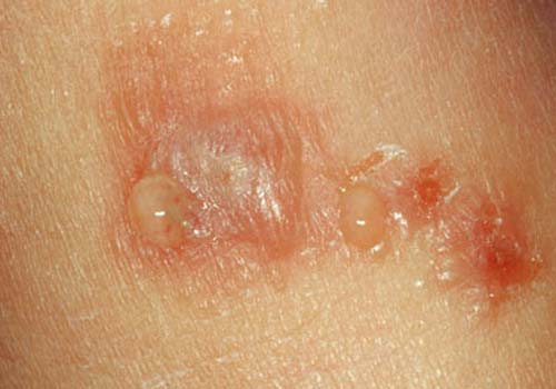 Tổng hợp hình ảnh bệnh eczema ở người lớn và trẻ sơ sinh 14