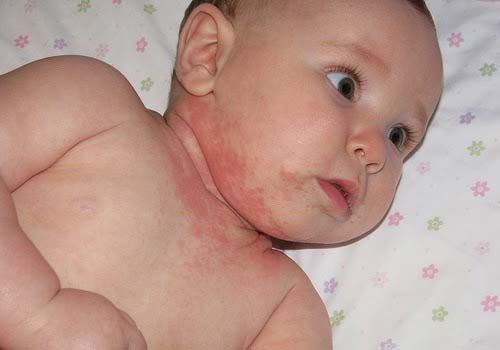 Tổng hợp hình ảnh bệnh eczema ở người lớn và trẻ sơ sinh 15