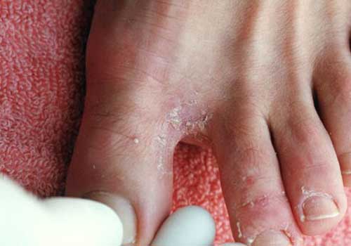 Bệnh nấm kẽ chân là gì? triệu chứng cách chữa và cách phòng tránh 1