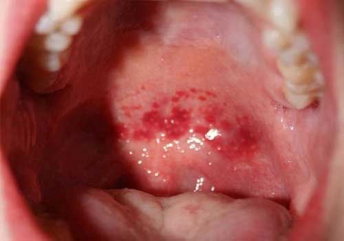 Bệnh viêm họng hạt là gì? Triệu chứng, nguyên nhân và cách chữa 3