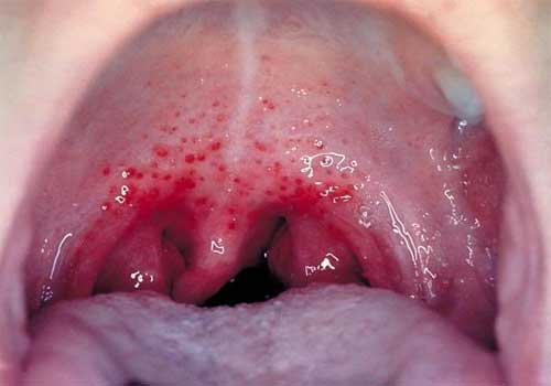 Bệnh viêm họng hạt là gì? Triệu chứng, nguyên nhân và cách chữa 2