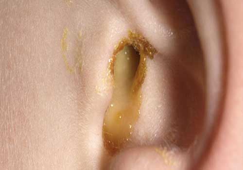 Chảy mủ ở tai có phải viêm tai giữa?